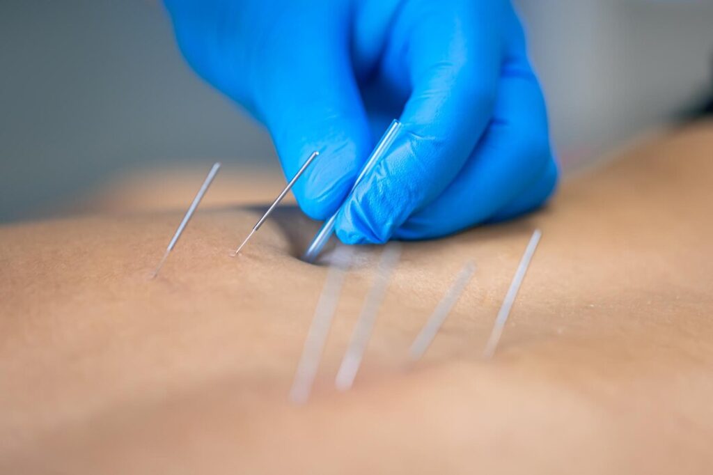 Acupuncture Ajax | Body Care Physio