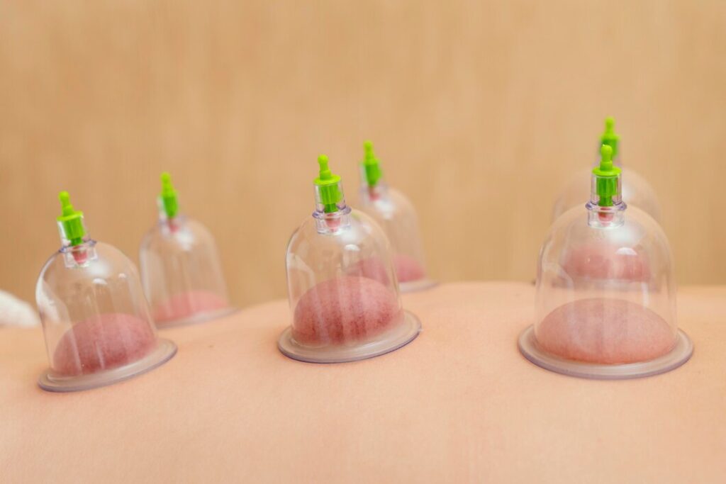 Cupping therapy Ajax | Body Care Physio